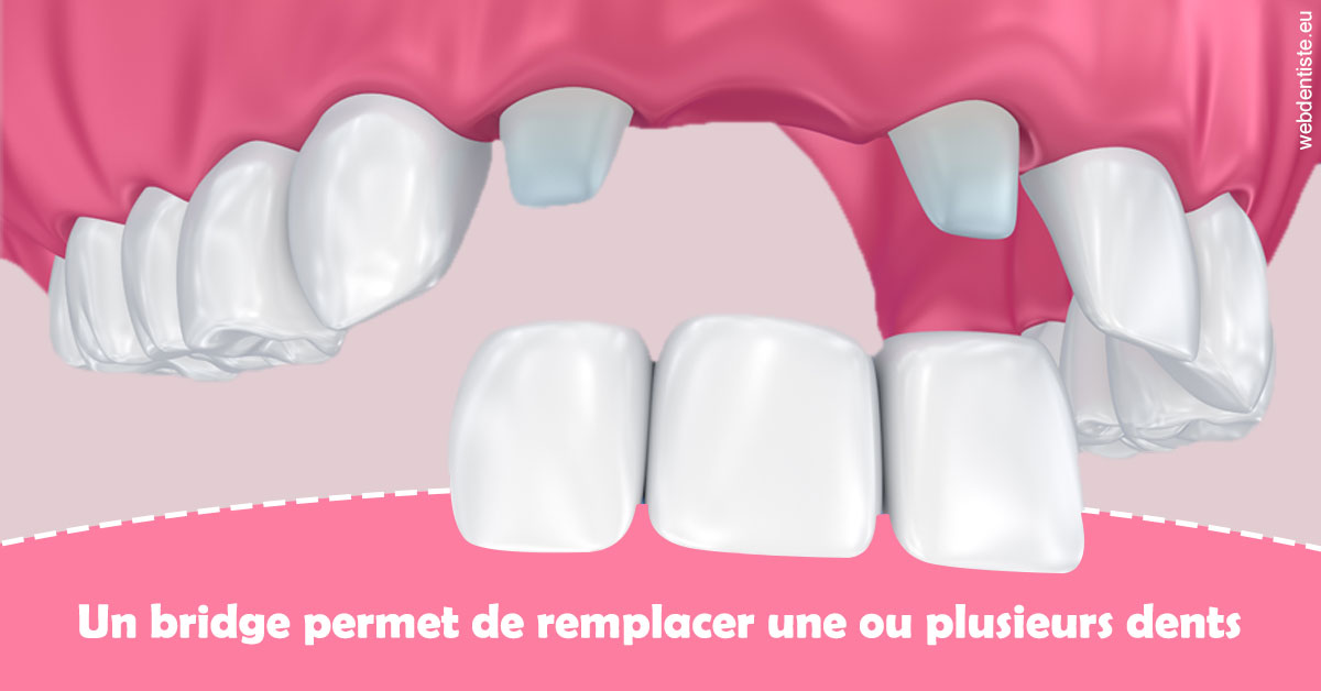 https://www.selarl-dentistes-le-canet.fr/Bridge remplacer dents 2
