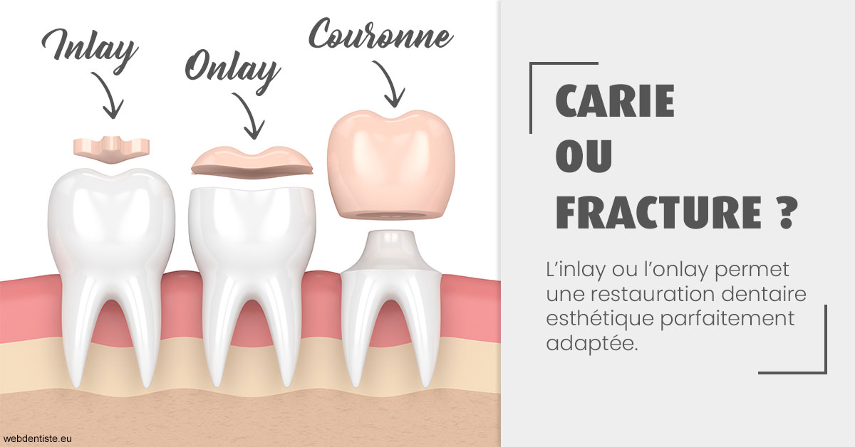 https://www.selarl-dentistes-le-canet.fr/T2 2023 - Carie ou fracture 1