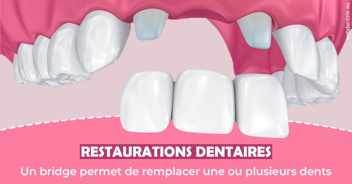 https://www.selarl-dentistes-le-canet.fr/Bridge remplacer dents 2