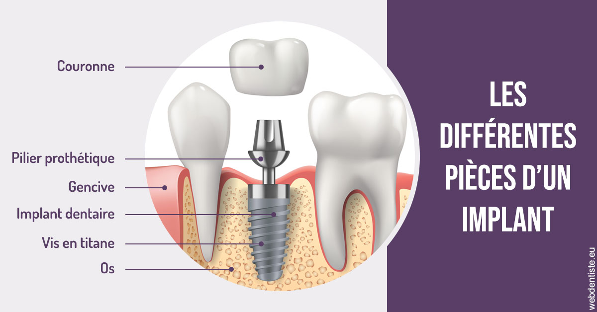 https://www.selarl-dentistes-le-canet.fr/Les différentes pièces d’un implant 2