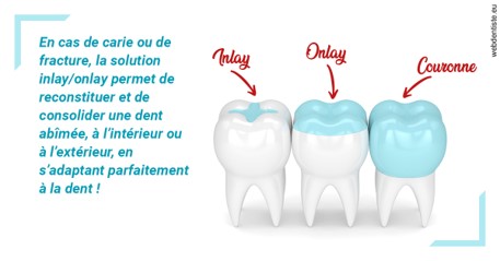 https://www.selarl-dentistes-le-canet.fr/L'INLAY ou l'ONLAY