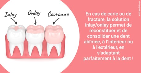 https://www.selarl-dentistes-le-canet.fr/L'INLAY ou l'ONLAY 2