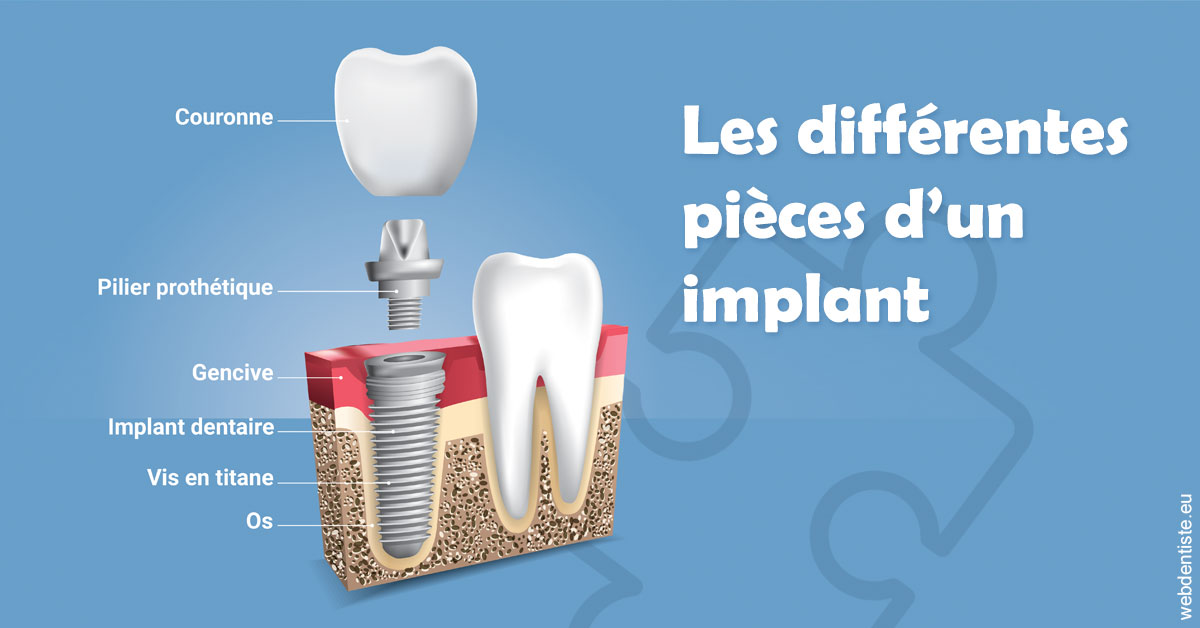 https://www.selarl-dentistes-le-canet.fr/Les différentes pièces d’un implant 1