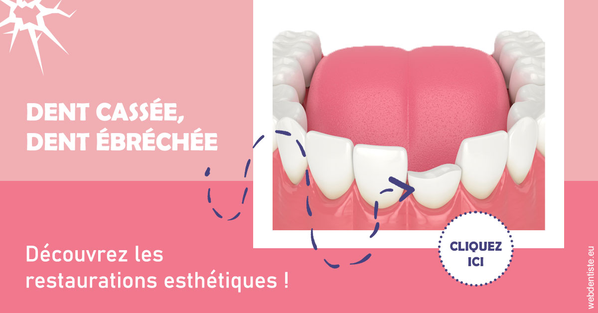 https://www.selarl-dentistes-le-canet.fr/Dent cassée ébréchée 1